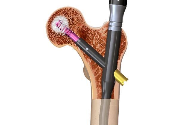 Arthrex - BoneSync Fast-Setting Drillable Calcium Phosphate Cement